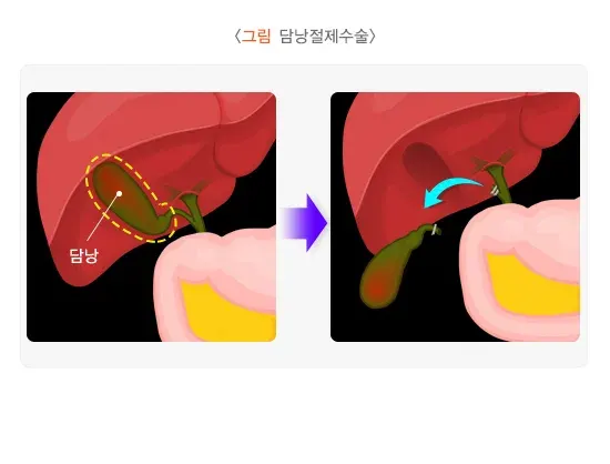 담낭염 치료 설명 이미지 1