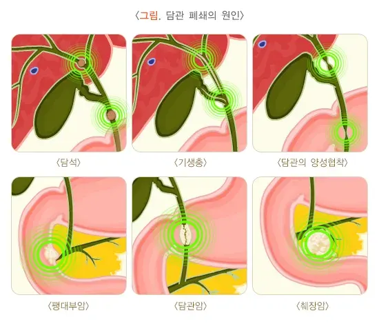 담관염 원인 설명 이미지 1