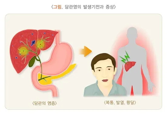 담관염 증상 설명 이미지 1