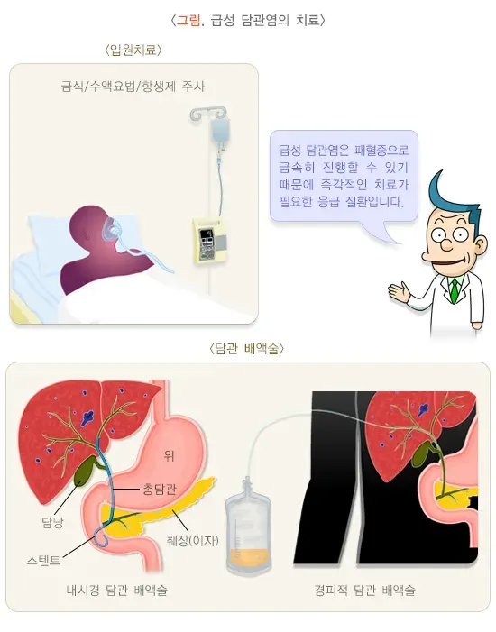 담관염 치료 설명 이미지 1