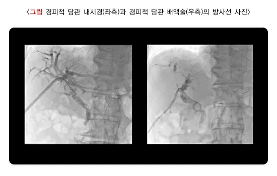 담관염 비약물 치료 설명 이미지 3