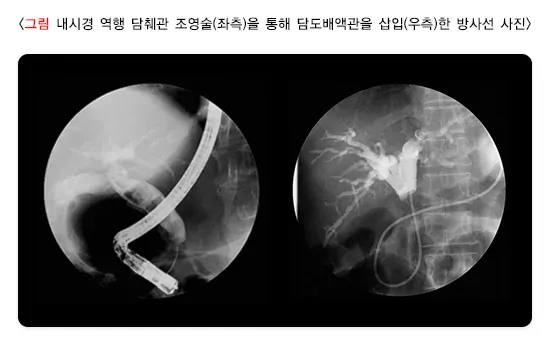 담관염 비약물 치료 설명 이미지 2