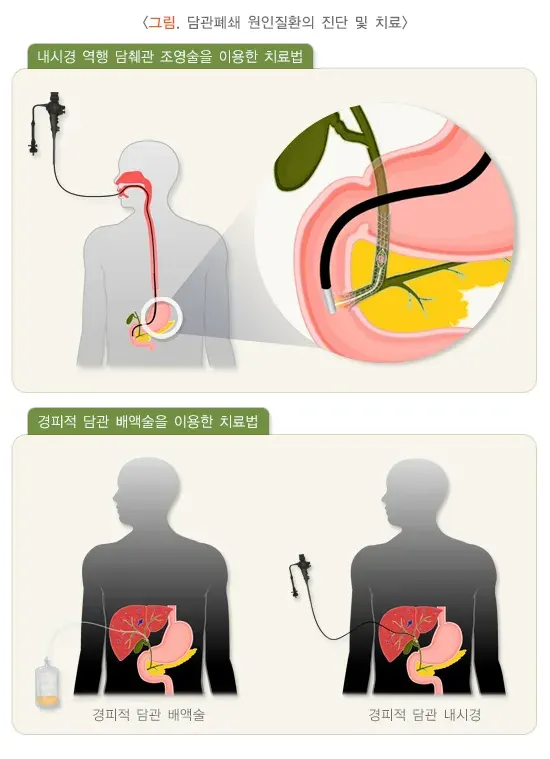 담관염 비약물 치료 설명 이미지 1