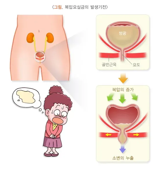 요실금 종류 설명 이미지 1