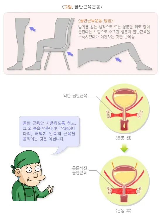 요실금 비약물 치료 설명 이미지 2