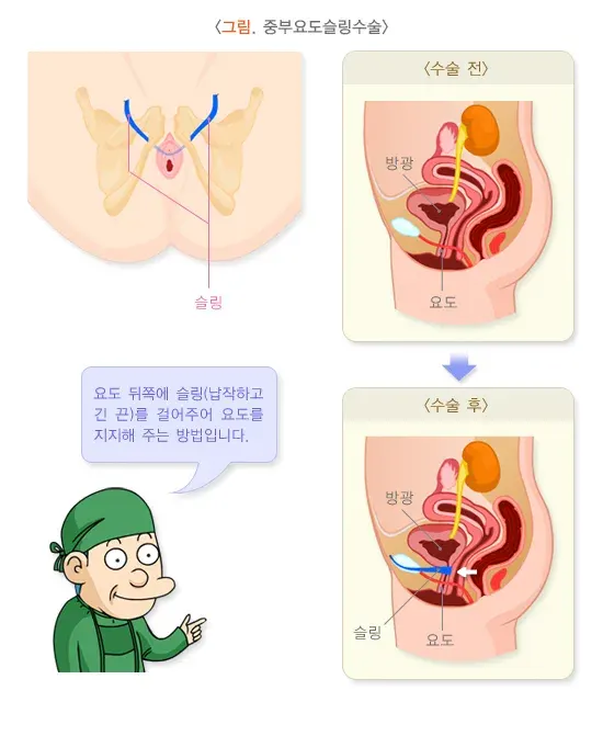 요실금 비약물 치료 설명 이미지 1