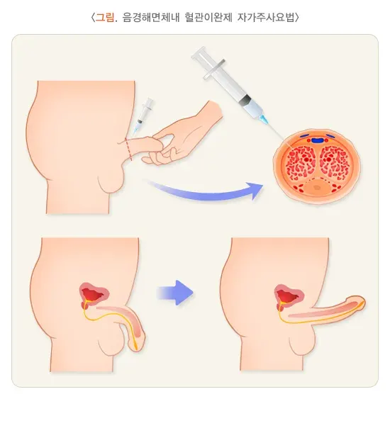발기부전 약물 치료 설명 이미지 1