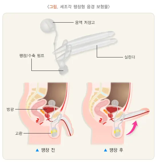 발기부전 비약물 치료 설명 이미지 2