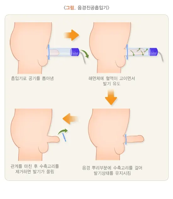 발기부전 비약물 치료 설명 이미지 1