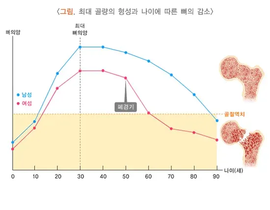 골다공증 종류 설명 이미지 1