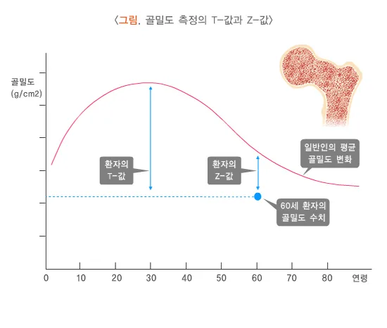 골다공증 진단 및 검사 설명 이미지 2