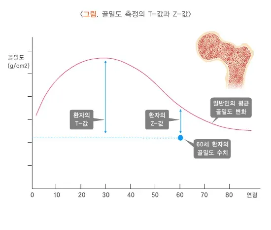 골다공증 진단 및 검사 설명 이미지 2