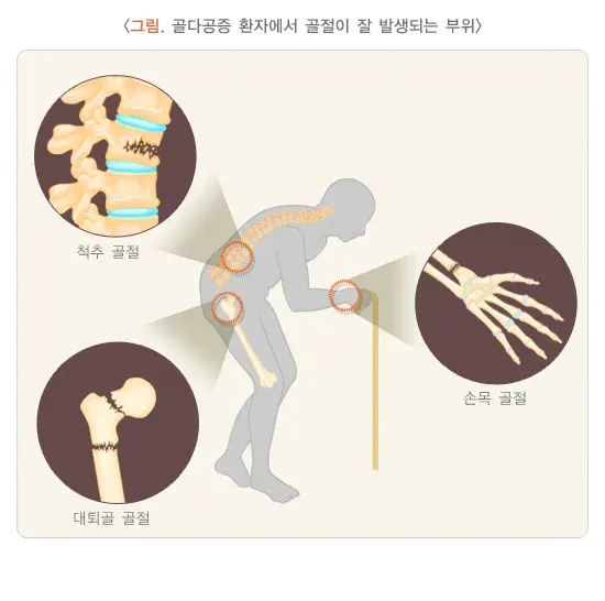 골다공증 연관 증상 설명 이미지 1