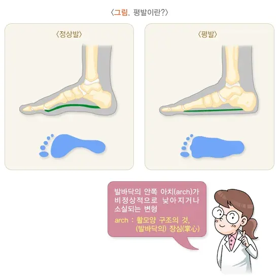 평발(편평족) 정의 설명 이미지 1