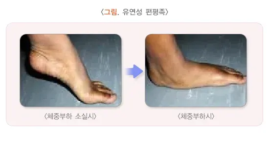 평발(편평족) 종류 설명 이미지 1