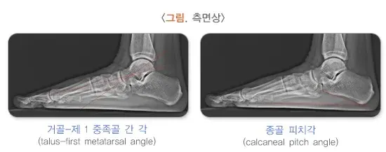 평발(편평족) 진단 및 검사 설명 이미지 3