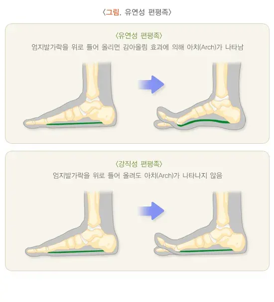 평발(편평족) 진단 및 검사 설명 이미지 1