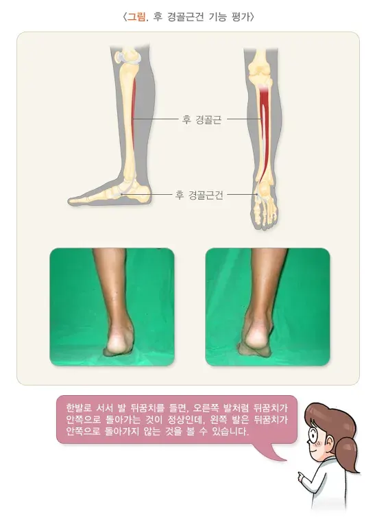 평발(편평족) 진단 및 검사 설명 이미지 2