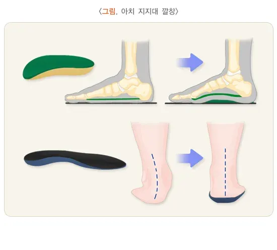평발(편평족) 치료 설명 이미지 1