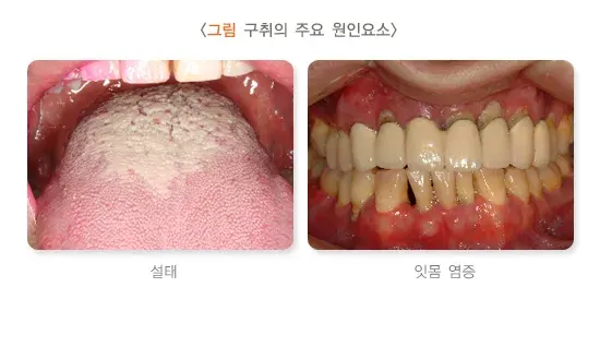 구취 원인 설명 이미지 1