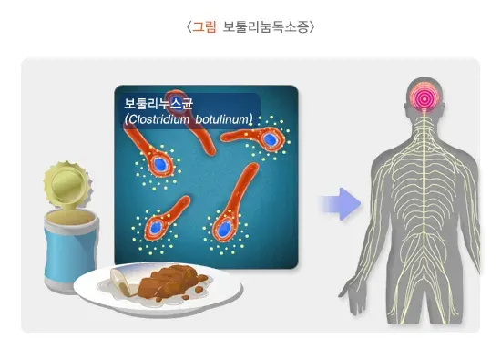 보툴리눔독소증 원인 및 감염경로 설명 이미지 1