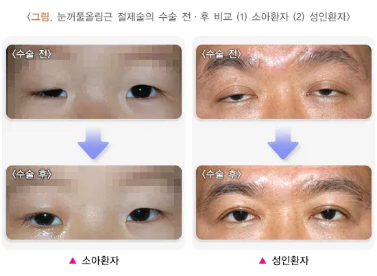 눈꺼풀처짐(안검하수) 치료 설명 이미지 1