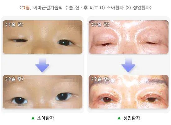 눈꺼풀처짐(안검하수) 치료 설명 이미지 2