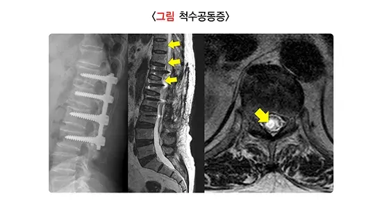 외상성 척수손상 발생원/원인 설명 이미지 1