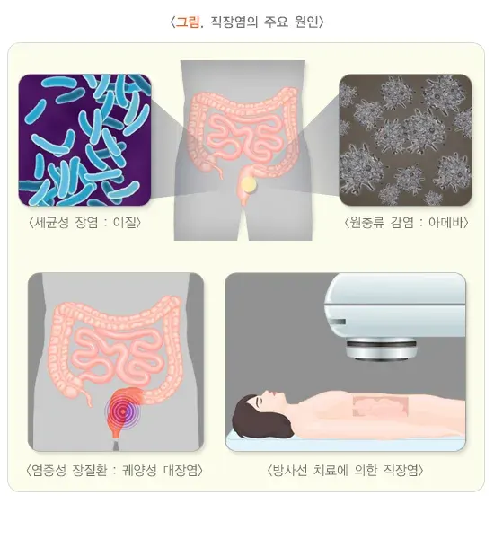 직장염 원인 설명 이미지 1