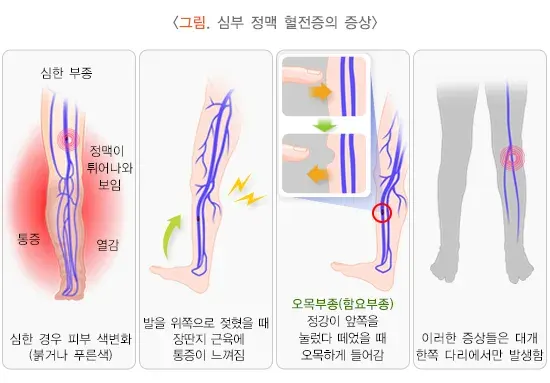 심부 정맥 혈전증 증상 설명 이미지 1