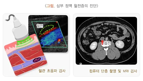 심부 정맥 혈전증 진단 및 검사 설명 이미지 1