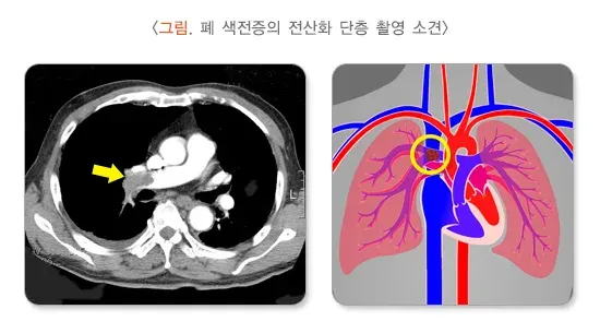 폐 색전증 진단 및 검사 설명 이미지 1