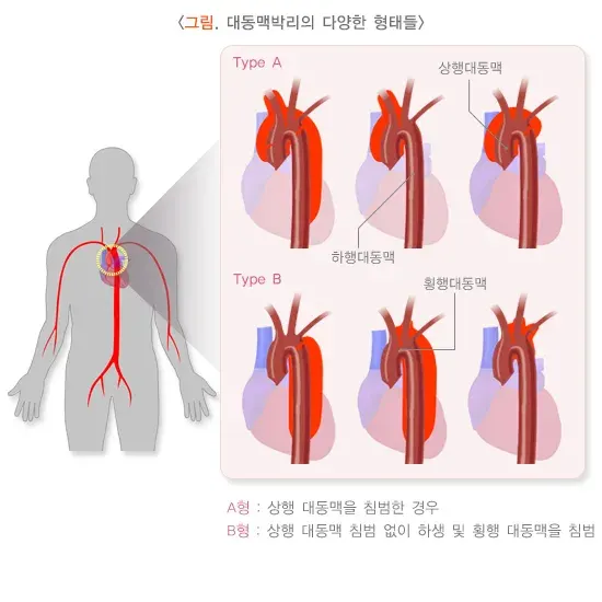 대동맥 박리 종류 설명 이미지 1