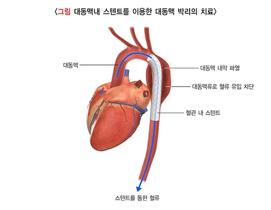 대동맥 박리 치료 설명 이미지 1