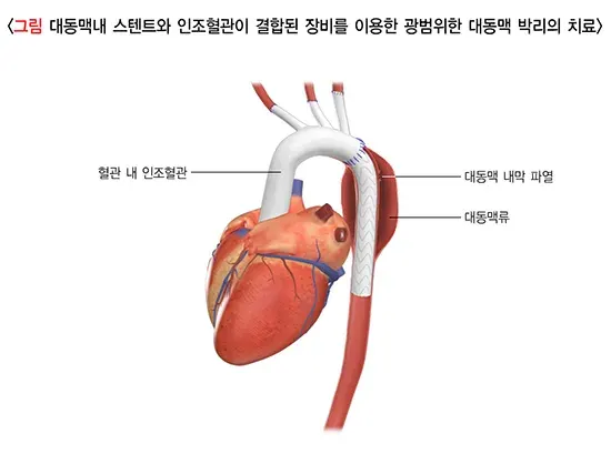 대동맥 박리 비약물 치료 설명 이미지 2