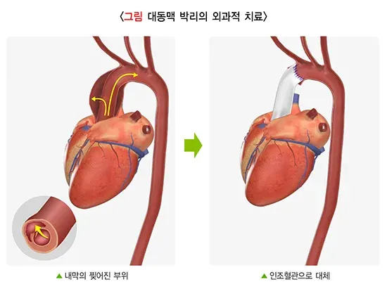 대동맥 박리 비약물 치료 설명 이미지 1