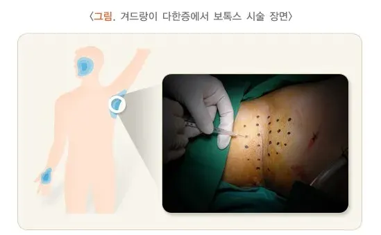 다한증 약물 치료 설명 이미지 1