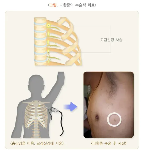 다한증 비약물 치료 설명 이미지 1