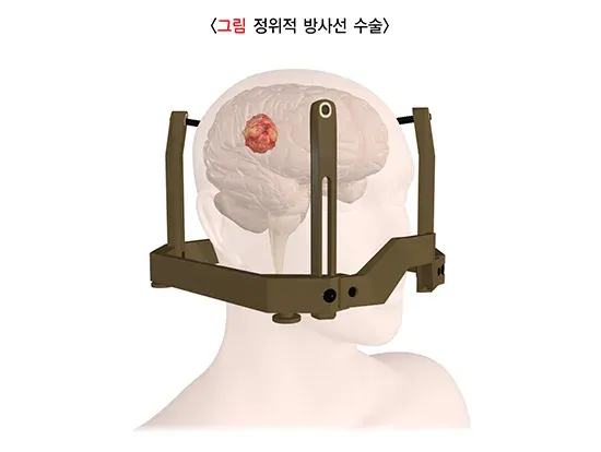 감마나이프 방사선 수술 치료 방법 설명 이미지 1