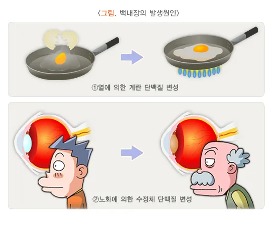 백내장 병태생리 설명 이미지 1
