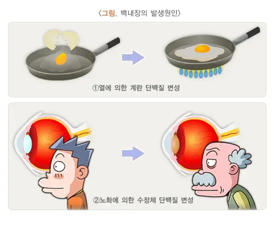 백내장 병태생리 설명 이미지 1