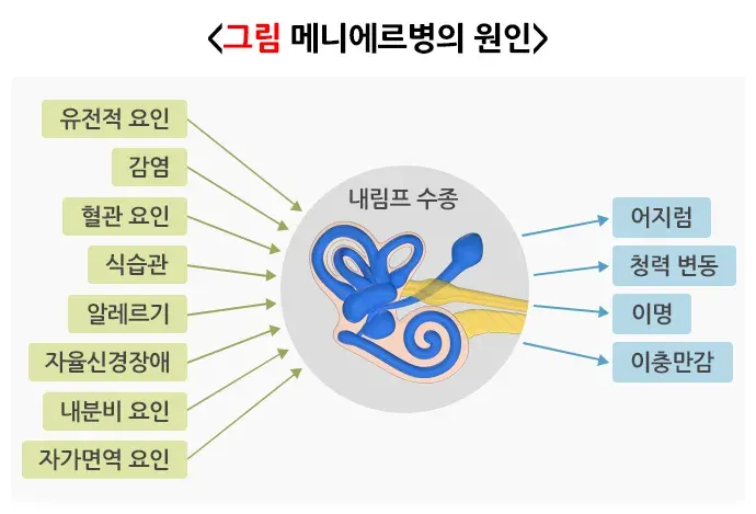 메니에르병 원인 설명 이미지 2