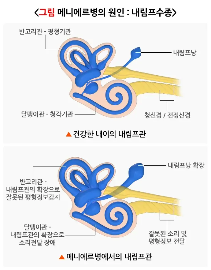 메니에르병 원인 설명 이미지 1
