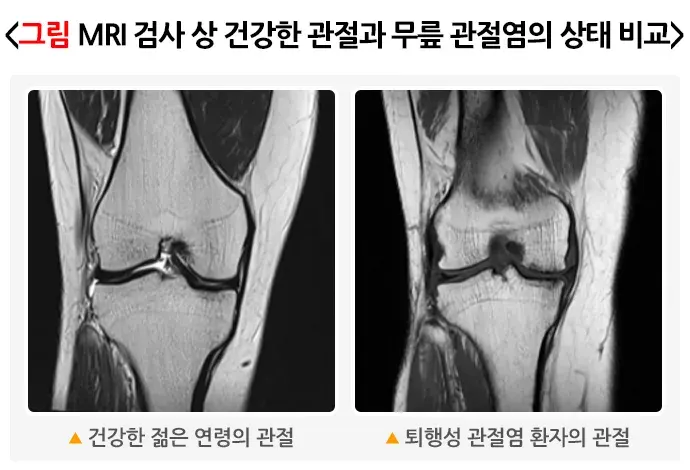 무릎관절염, 올바로 운동하기 평가 및 검사 설명 이미지 2