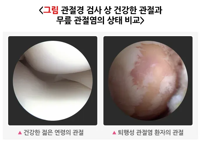 무릎관절염, 올바로 운동하기 평가 및 검사 설명 이미지 3