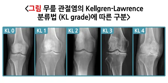 무릎관절염, 올바로 운동하기 평가 및 검사 설명 이미지 1