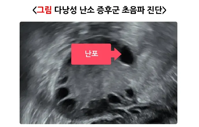 다낭성난소증후군 진단 및 검사 설명 이미지 1