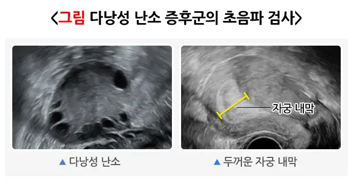 다낭성난소증후군 정기 진찰 설명 이미지 1