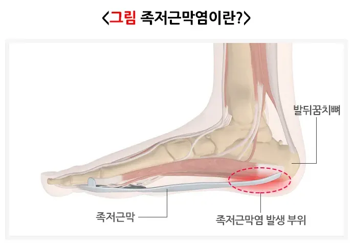 족저근막염 정의 설명 이미지 1