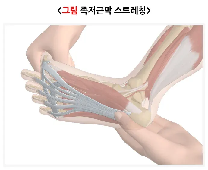 족저근막염 치료 설명 이미지 1